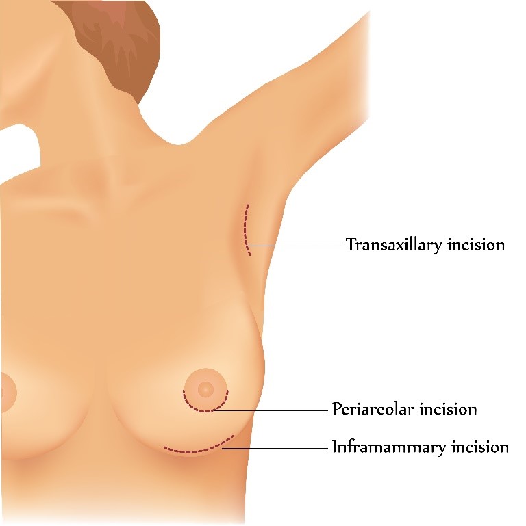 Breast Augmentation incision technique infographic