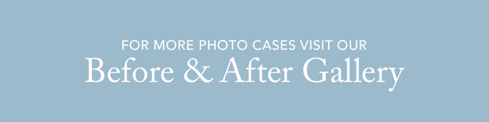 View our Eyelid Surgery Before and After Gallery