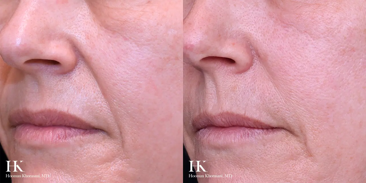 Nasolabial Fold Contouring with Facial Fillers by Dr. Hooman Khorasani