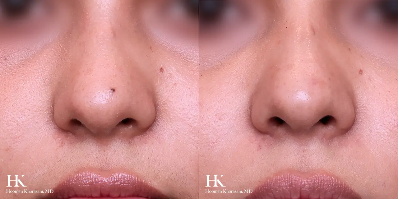Cosmetic Mole Removal on Nose by Laser by Dr. Hooman Khorasani