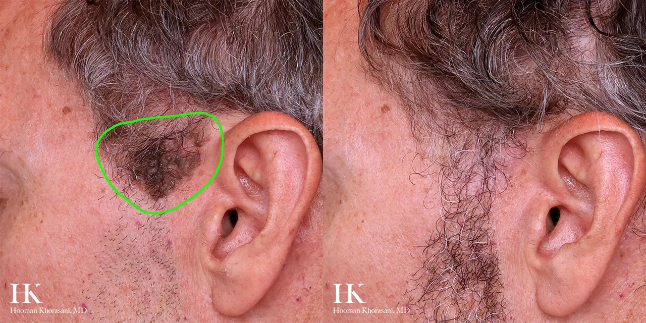 Cosmetic Mole Removal on Nose by Laser by Dr. Hooman Khorasani