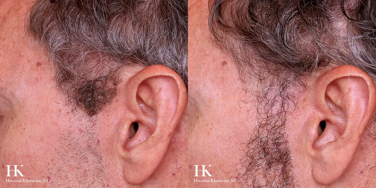 Cosmetic Mole Removal on Nose by Laser by Dr. Hooman Khorasani
