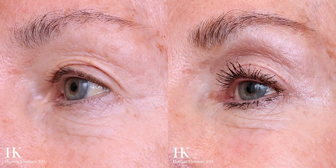 Eyelid Surgery Upper Blepharoplasty by Dr. Hooman Khorasani