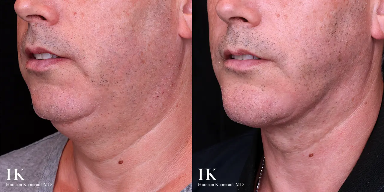 Liposuction of the Neck by Dr. Hooman Khorasani