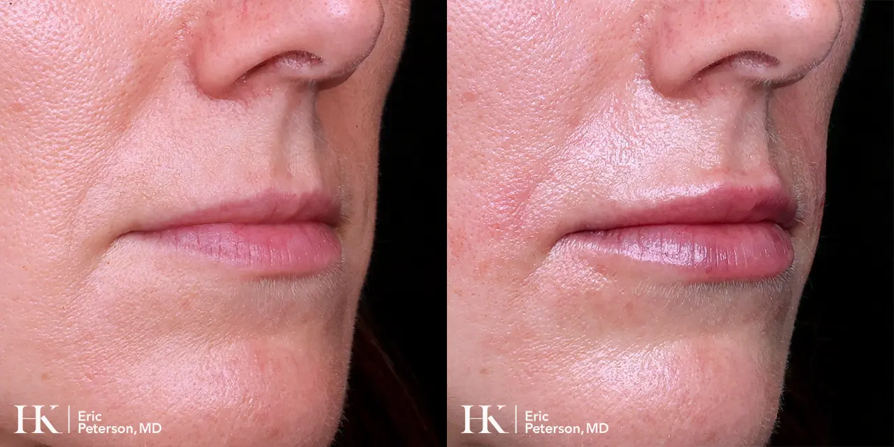 Lip Augmentation using Dermal Filler by Dr. Erik Peterson