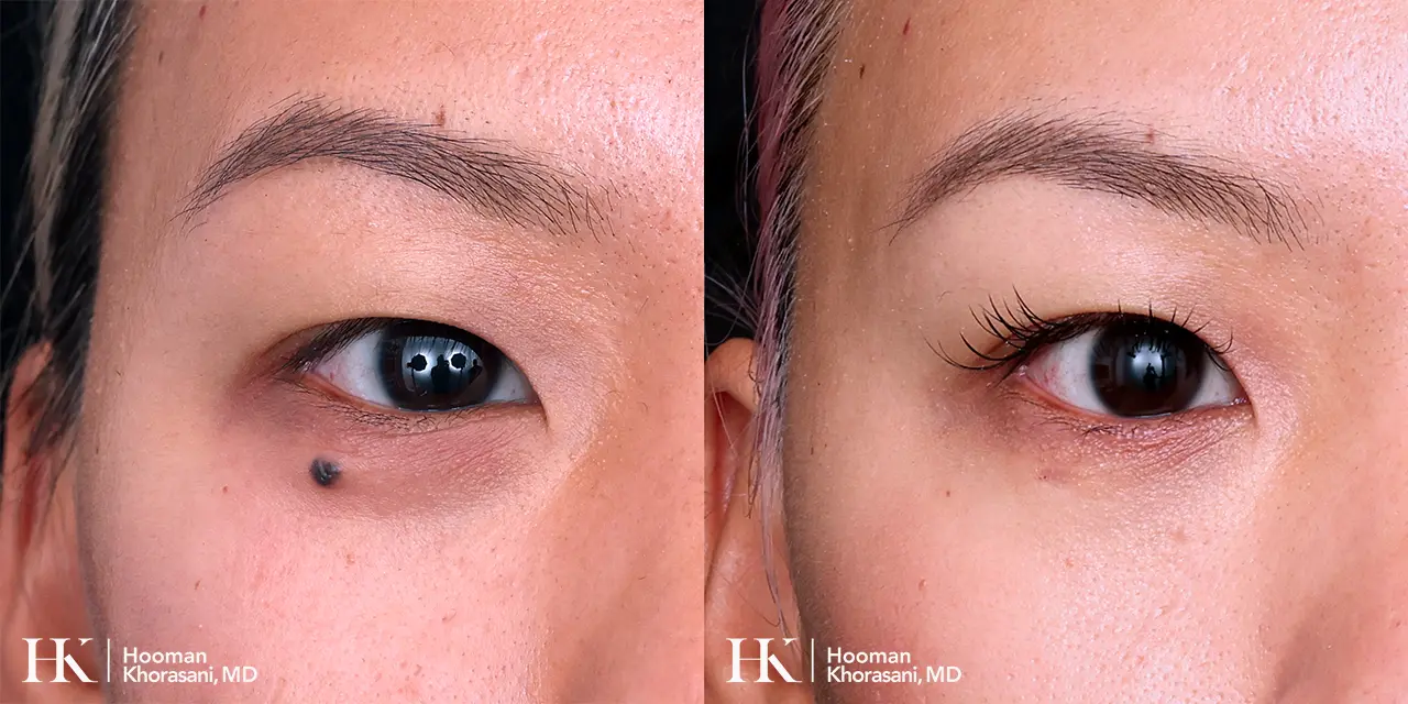 Cosmetic Mole Removal on Nose by Laser by Dr. Hooman Khorasani