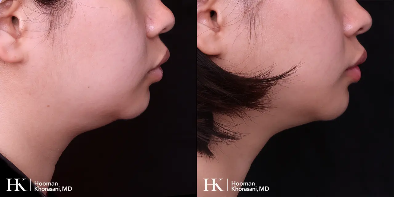 Liposuction of the Neck by Dr. Hooman Khorasani