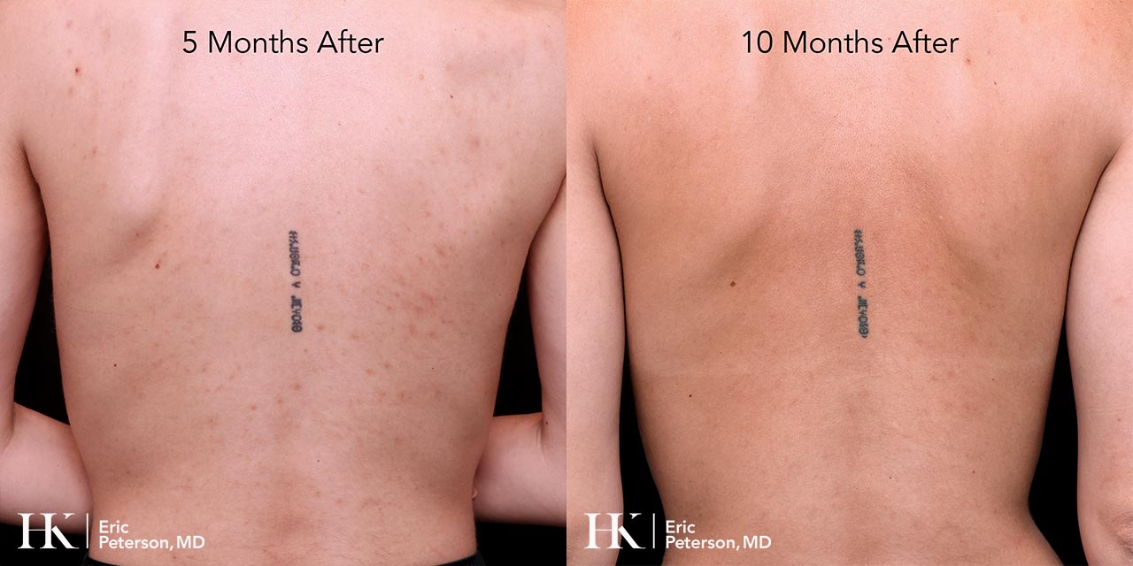 Acne Treatment using Accutane by Dr Erik Peterson