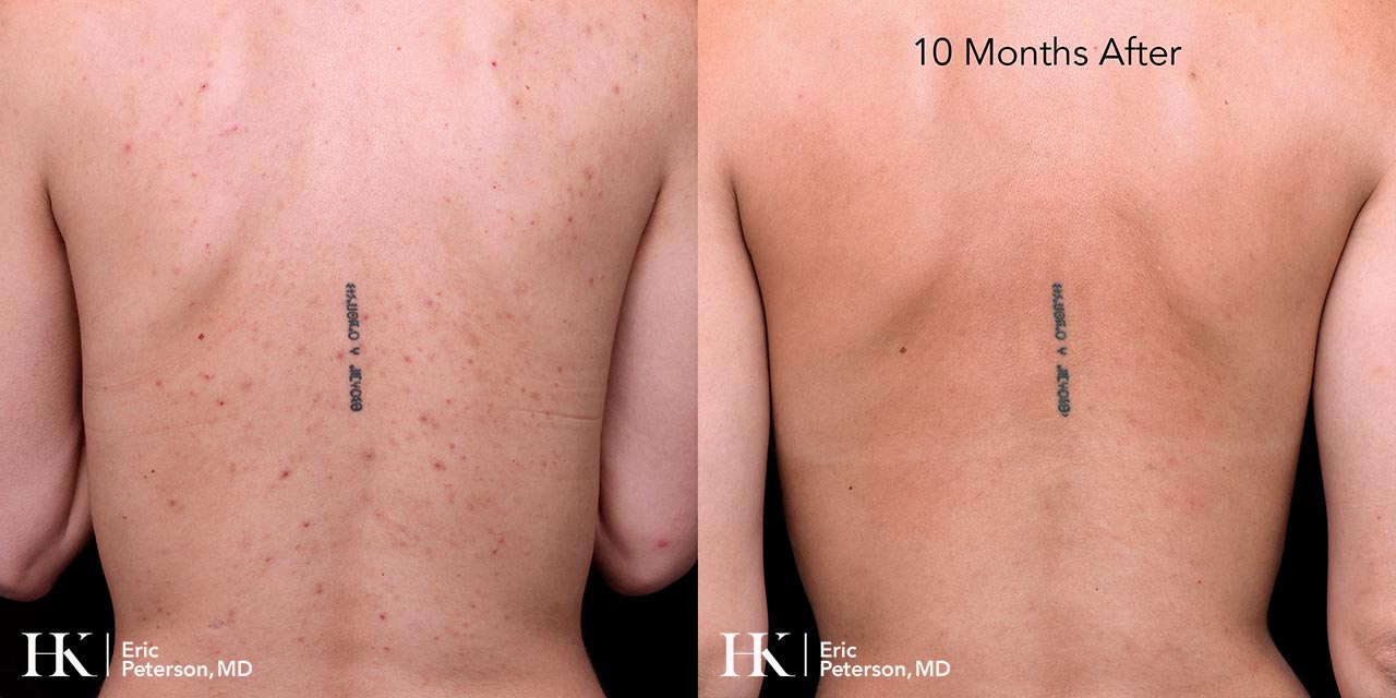 Acne Treatment using Accutane by Dr Erik Peterson