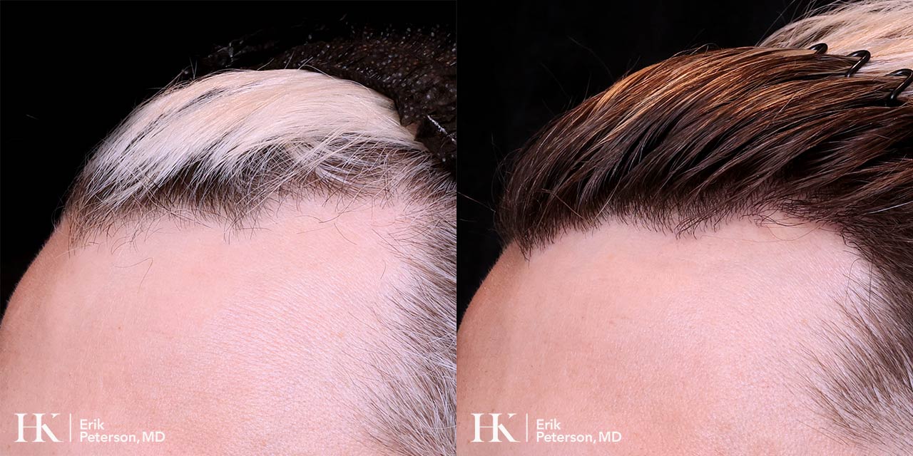 Surgical Hair Implants FUE by Dr. Erik Peterson