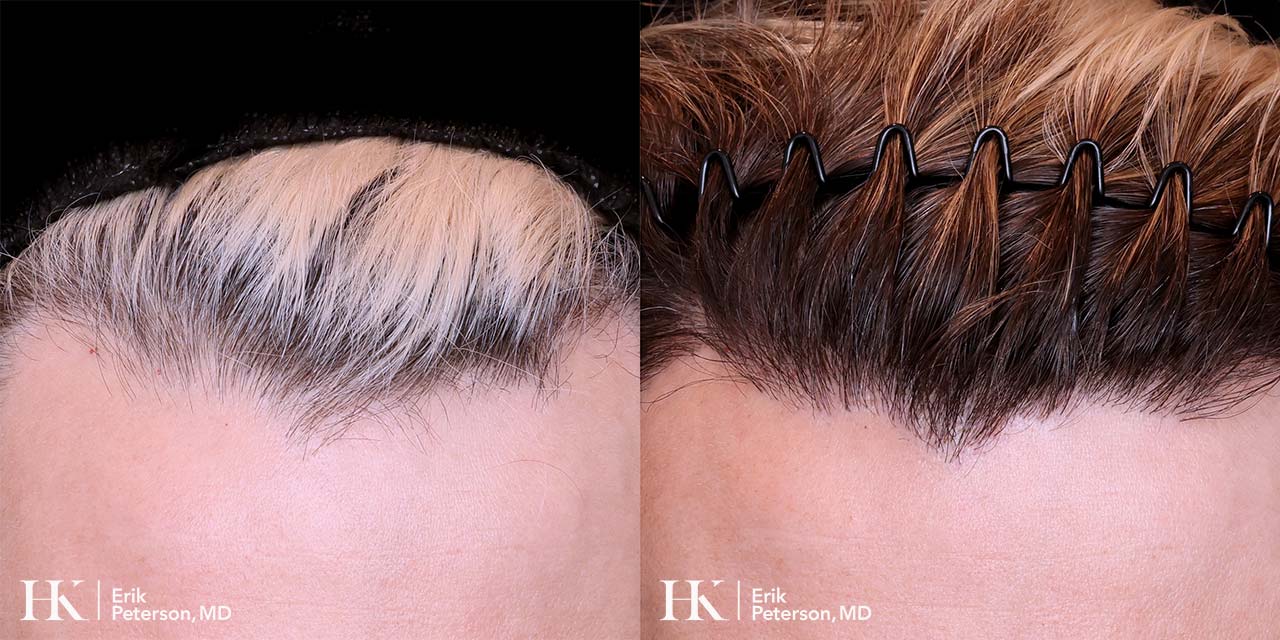 Surgical Hair Implants FUE by Dr. Erik Peterson