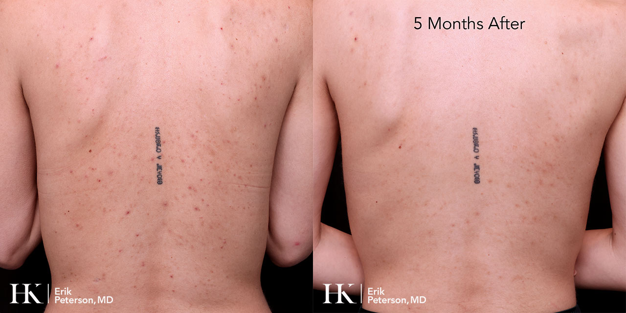 Acne Treatment using Accutane by Dr Erik Peterson