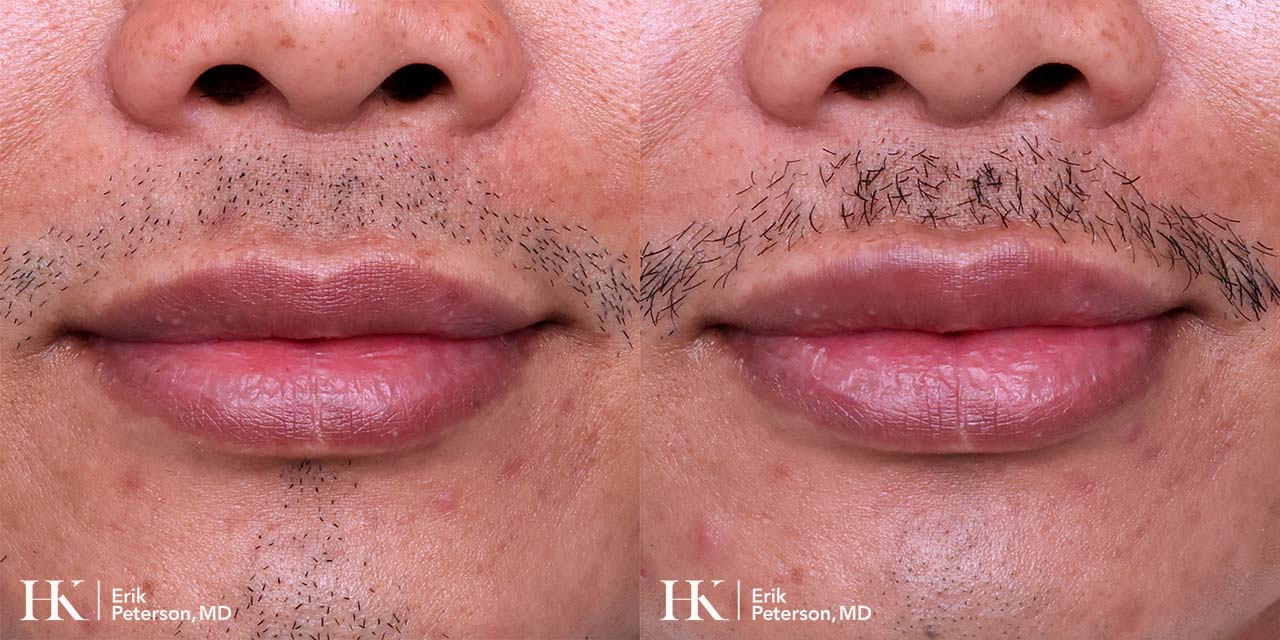 Lip Augmentation using Dermal Filler by Dr. Erik Peterson