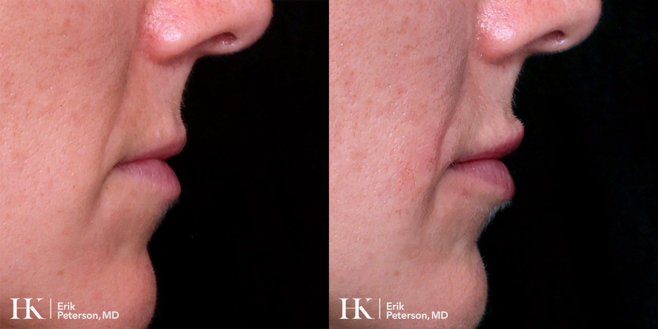 Lip Augmentation using Dermal Filler by Dr. Erik Peterson
