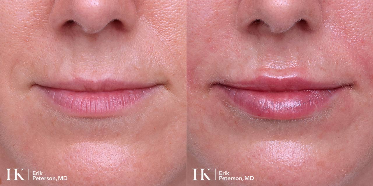 Lip Augmentation using Dermal Filler by Dr. Erik Peterson