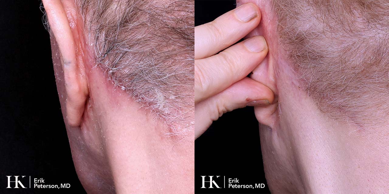 Scar Revision Using Dermabrasion, DeepFX Laser by Dr. Erik Peterson