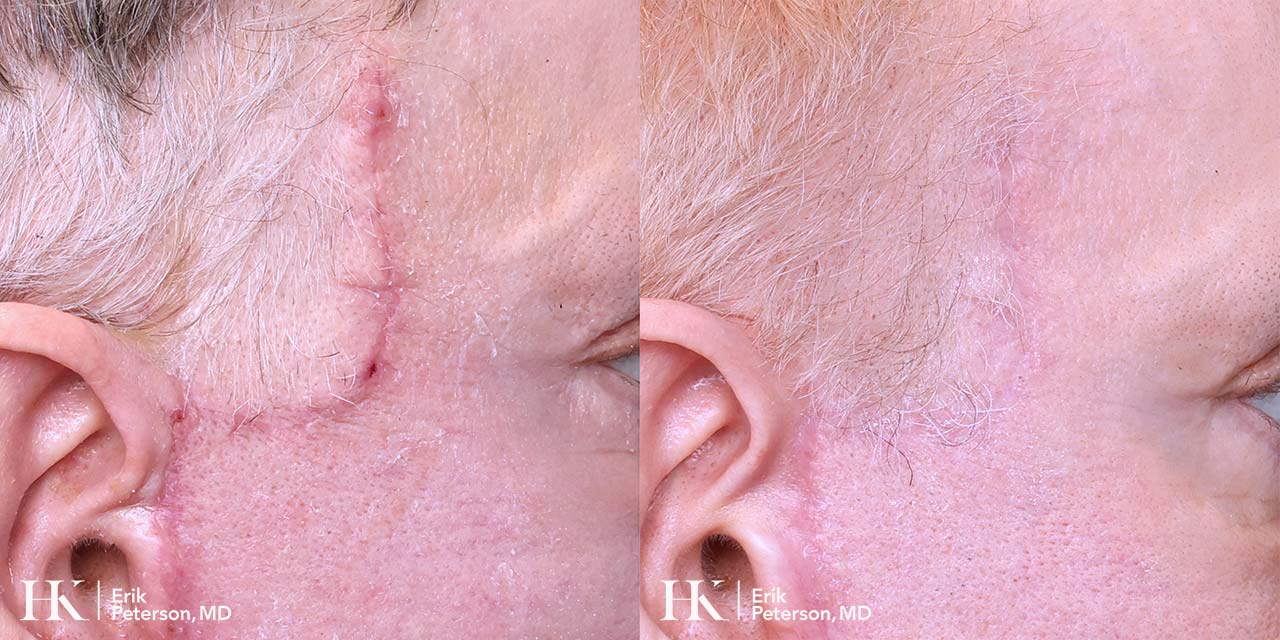 Scar Revision Using Dermabrasion, DeepFX Laser by Dr. Erik Peterson
