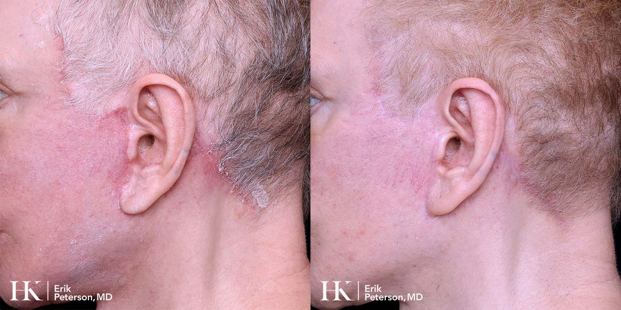 Scar Revision Using Dermabrasion, DeepFX Laser by Dr. Erik Peterson