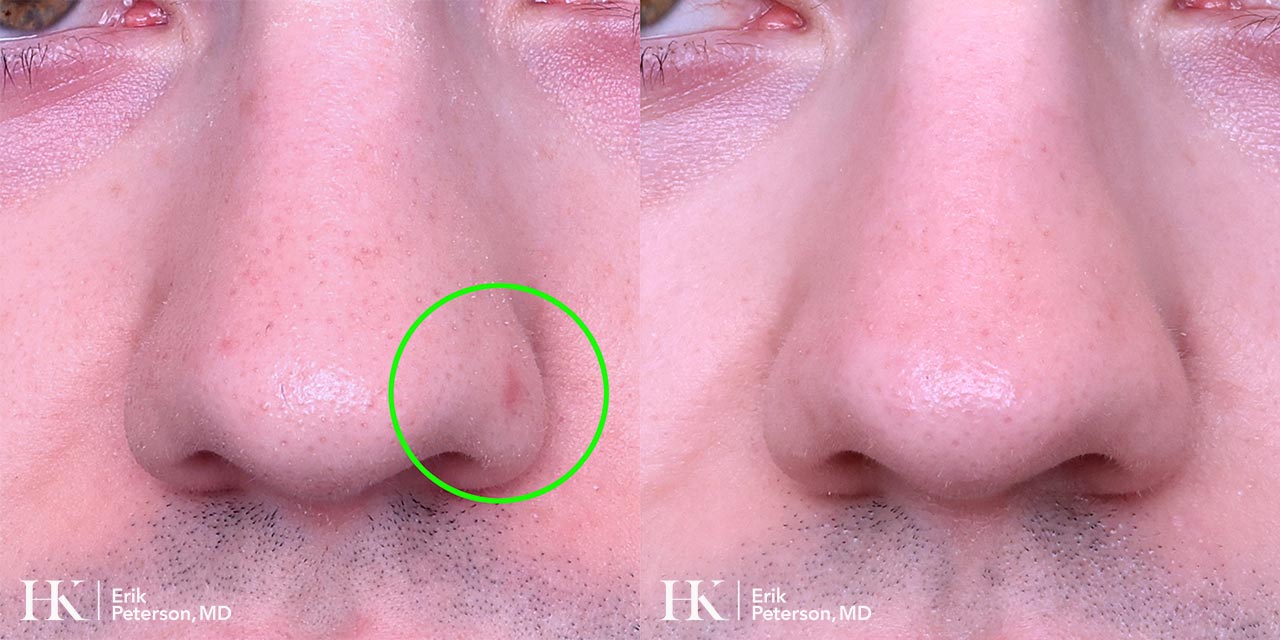 Vascular Laser Treatment for Redness using Vbeam Laser by Dr. Erik Peterson