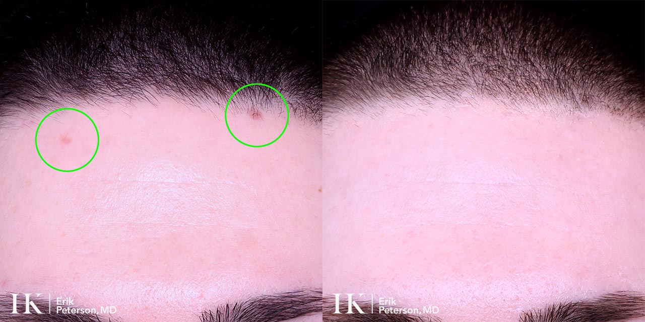 Vascular Laser Treatment for Redness using Vbeam Laser by Dr. Erik Peterson