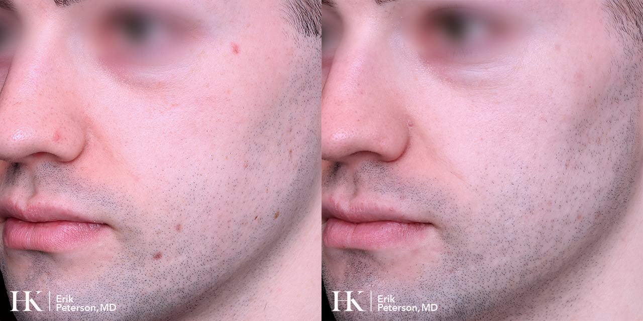 Vascular Laser Treatment for Redness using Vbeam Laser by Dr. Erik Peterson