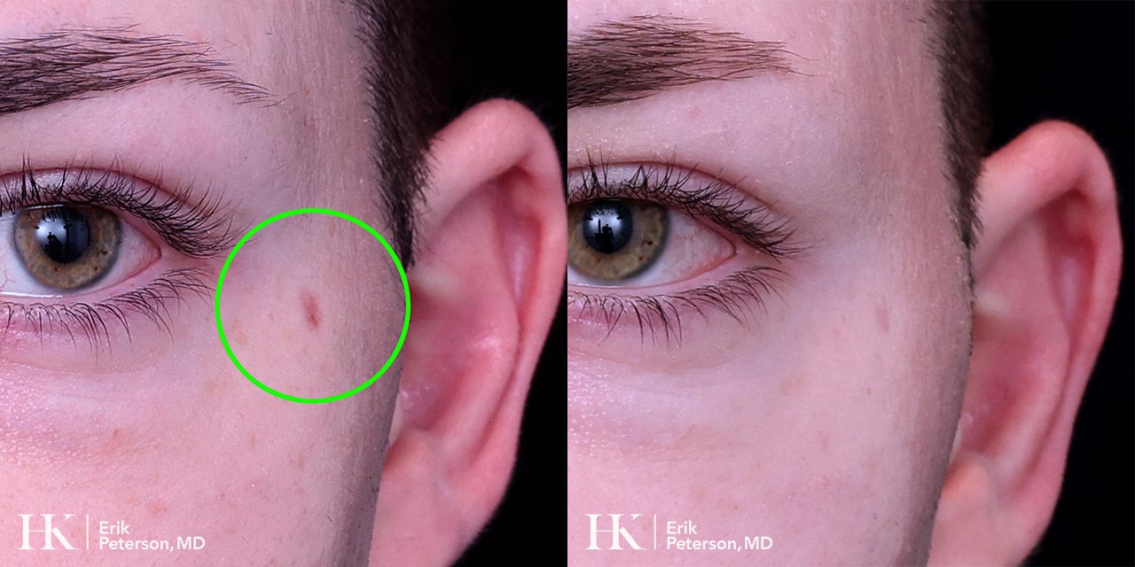 Vascular Laser Treatment for Redness using Vbeam Laser by Dr. Erik Peterson