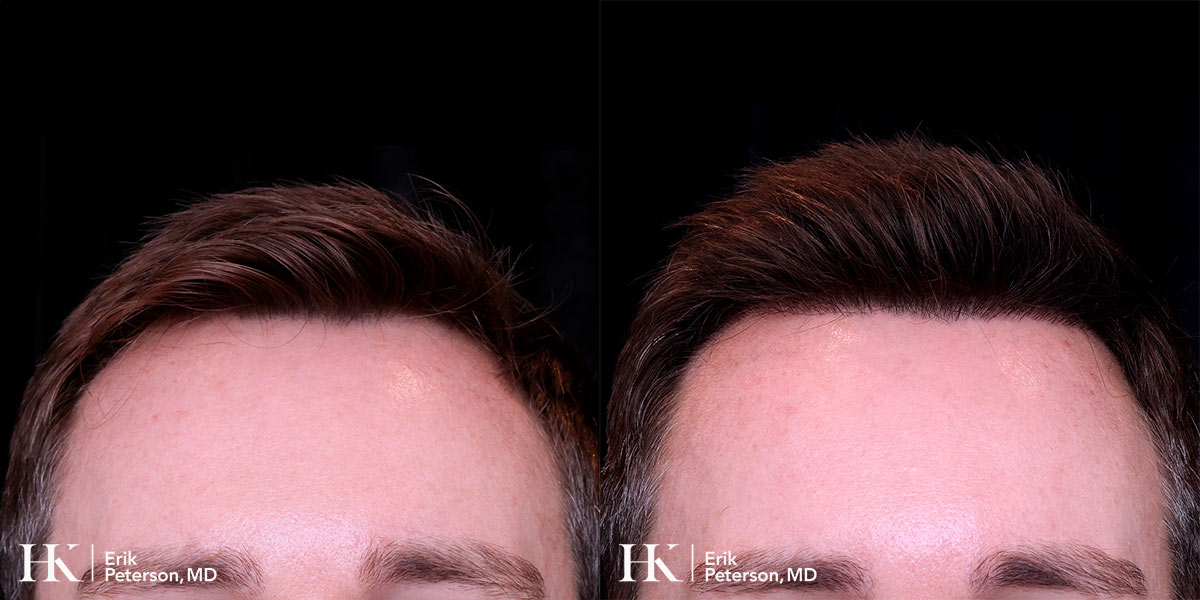 Surgical Hair Implants FUE by Dr. Erik Peterson