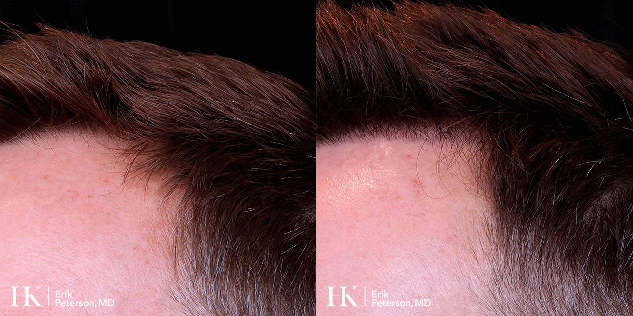 Surgical Hair Implants FUE by Dr. Erik Peterson
