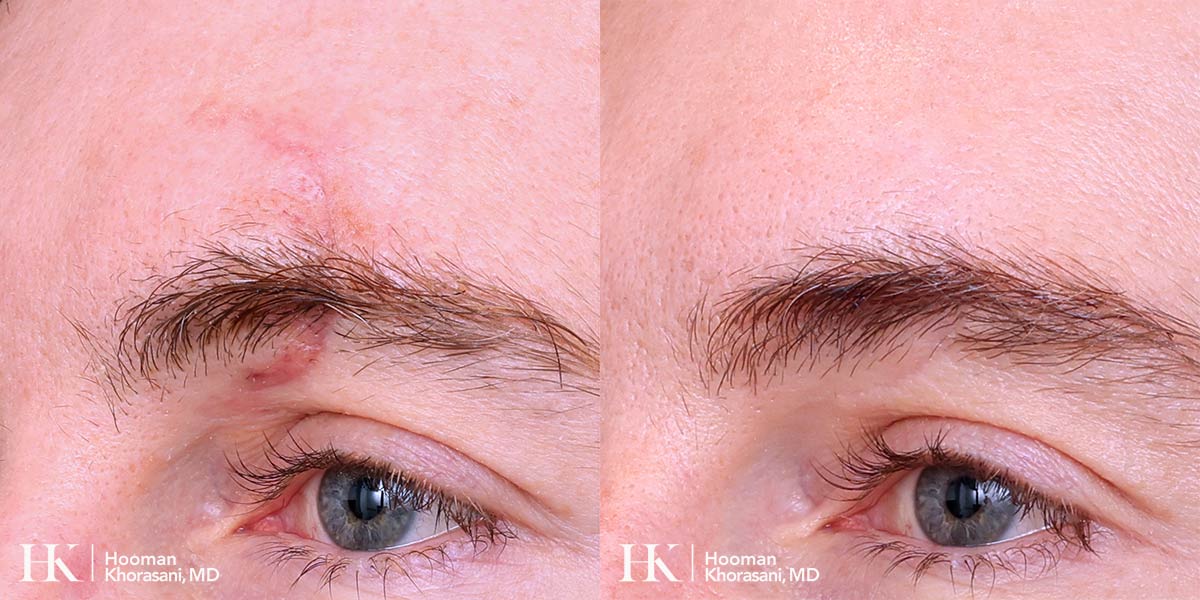 Scar Revision Using Dermabrasion, Co2 Laser by Dr. Hooman Khorasani