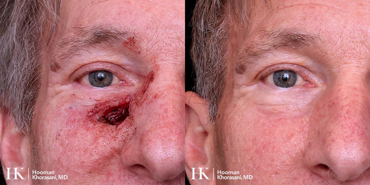 Mohs Micrographic Surgery & Reconstruction of the Cheek by Dr. Hooman Khorasani
