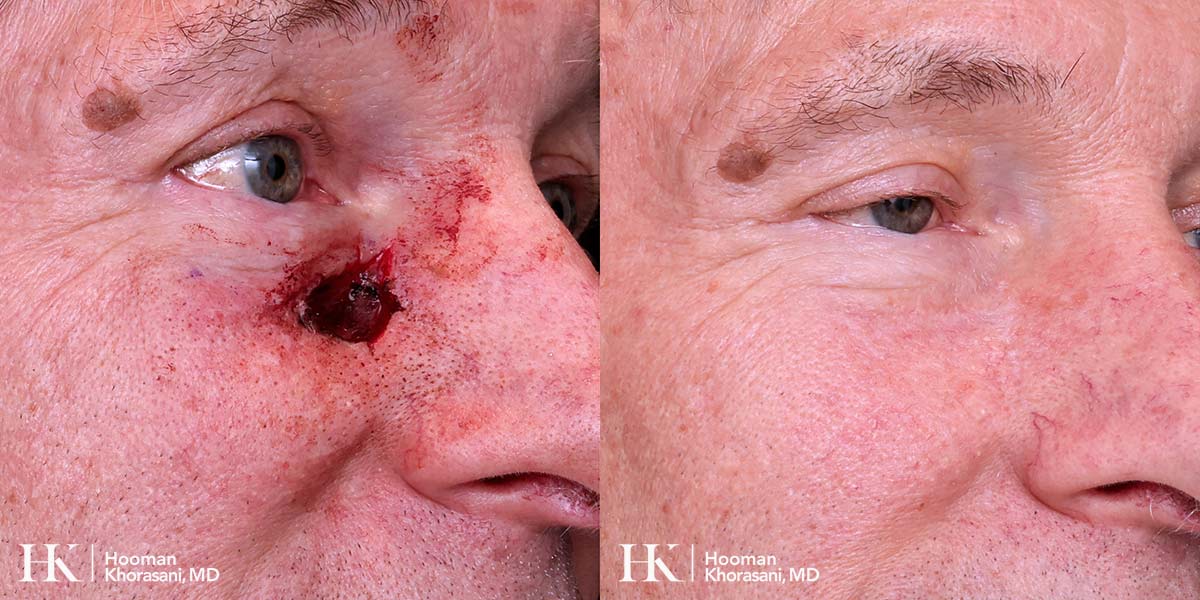 Mohs Micrographic Surgery & Reconstruction of the Cheek by Dr. Hooman Khorasani