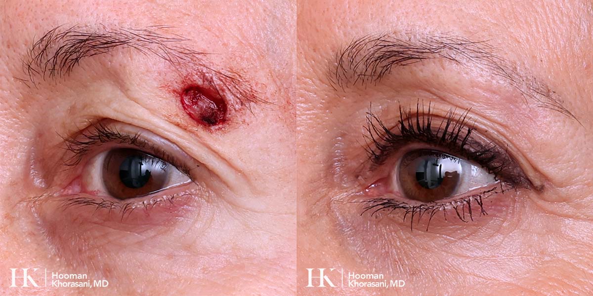 Mohs Micrographic Surgery & Reconstruction of the Eye by Dr. Hooman Khorasani