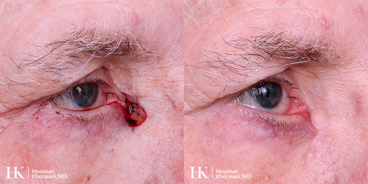Mohs Micrographic Surgery & Reconstruction of the Eye by Dr. Hooman Khorasani