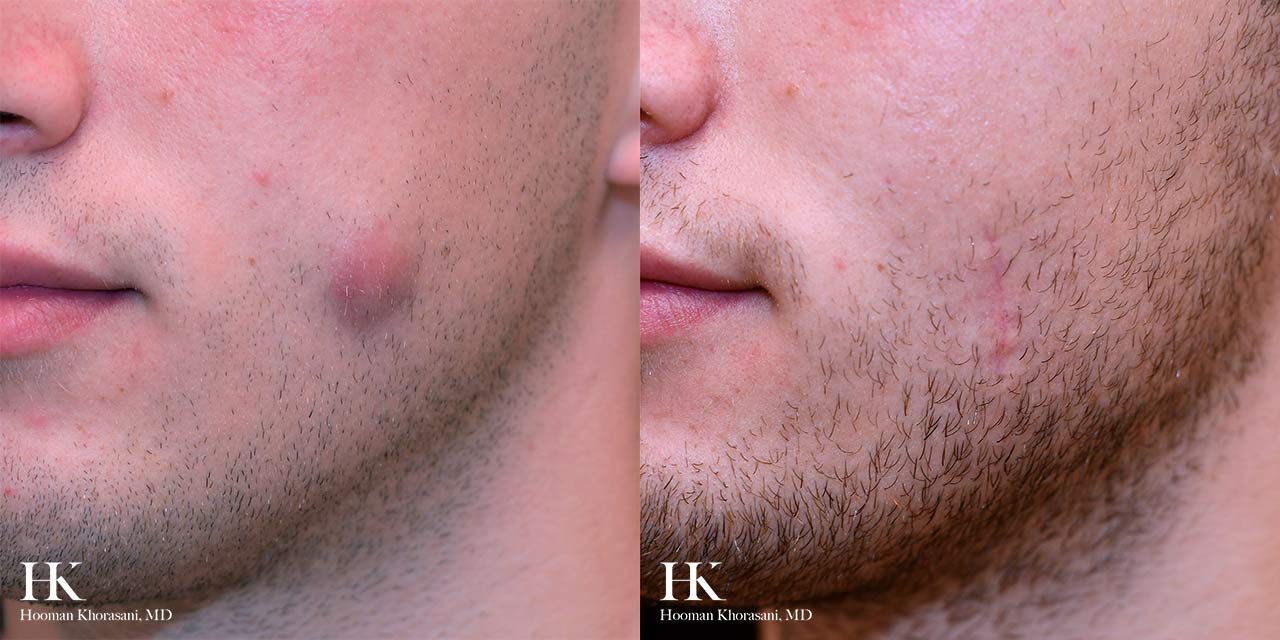 Cyst & Lipoma Removal Dr. Hooman Khorasani