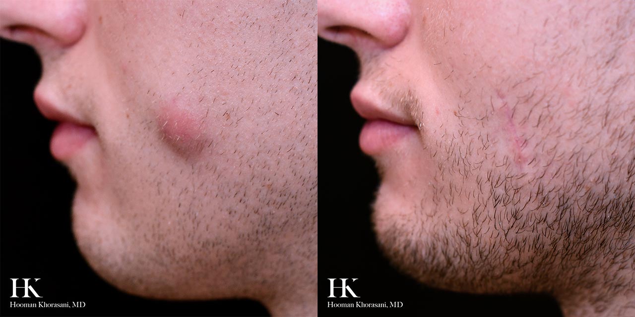 Cyst & Lipoma Removal Dr. Hooman Khorasani