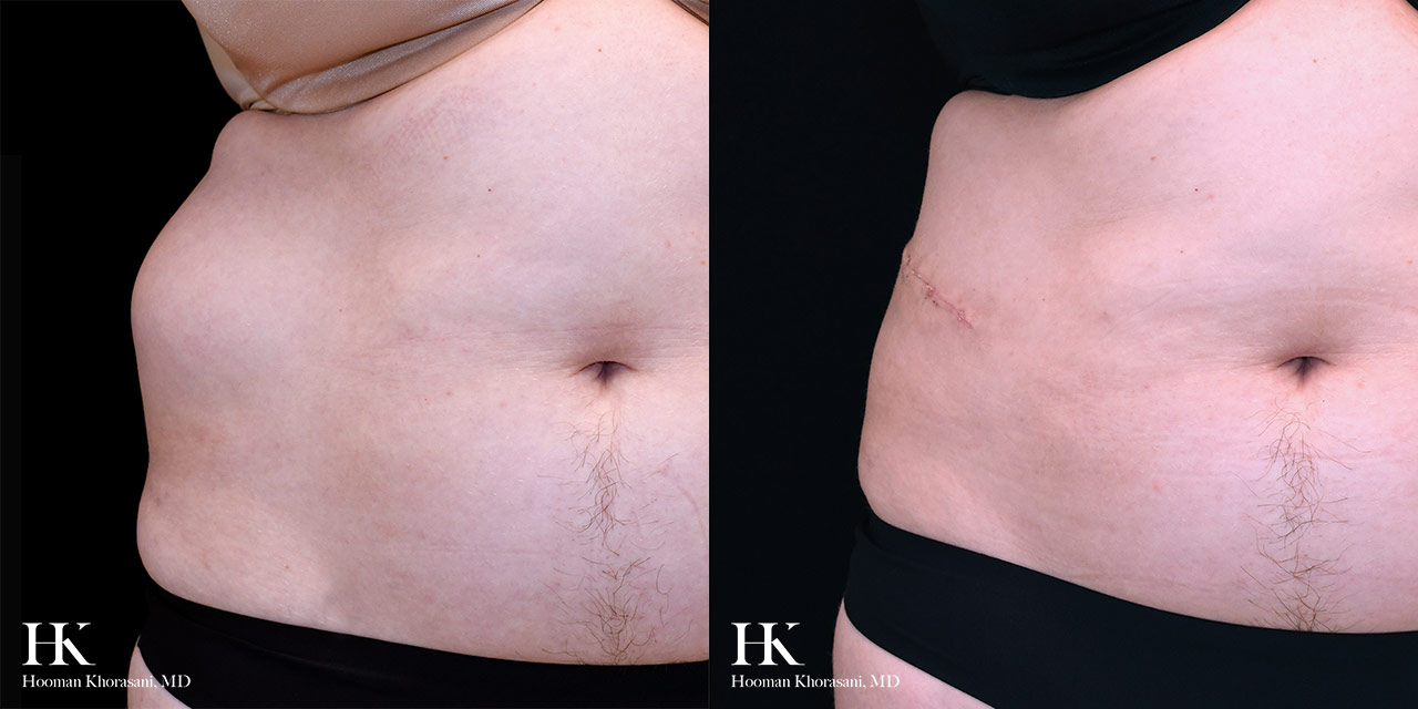 Cyst & Lipoma Removal Dr. Hooman Khorasani