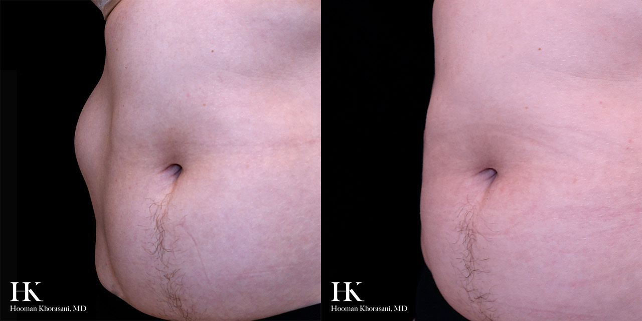 Cyst & Lipoma Removal Dr. Hooman Khorasani