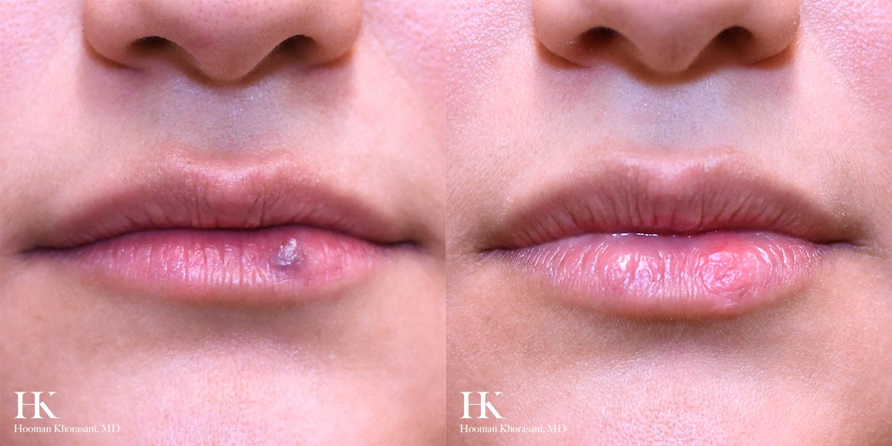 Cyst & Lipoma Removal Dr. Hooman Khorasani