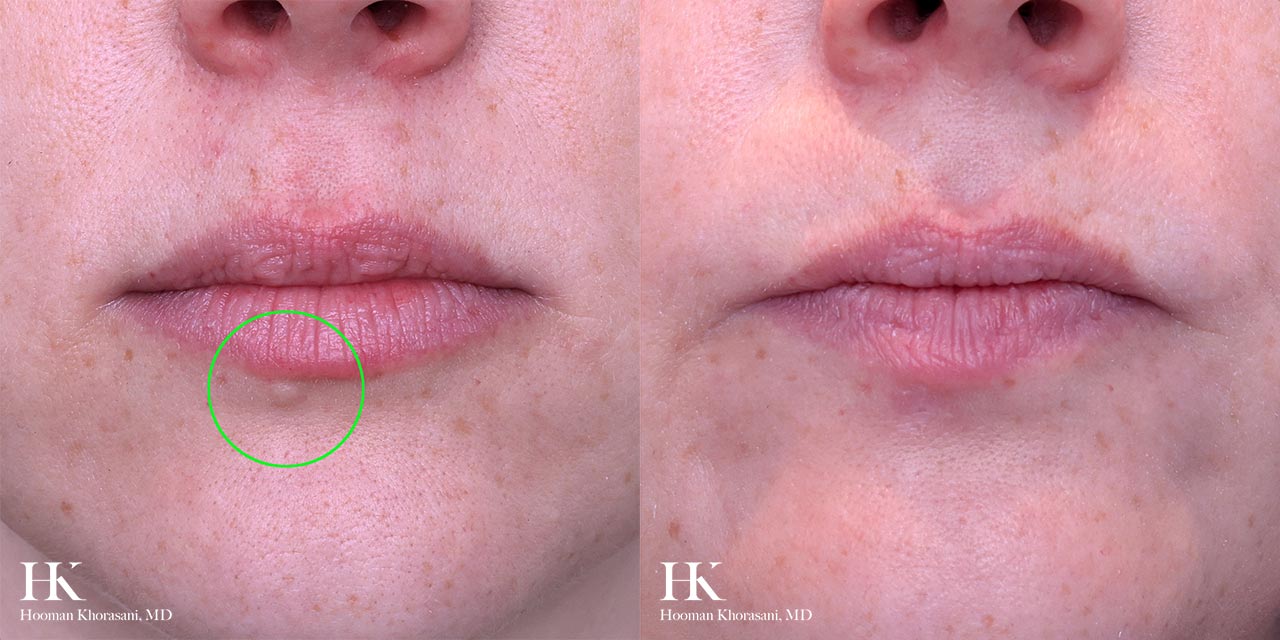 Cyst & Lipoma Removal Dr. Hooman Khorasani