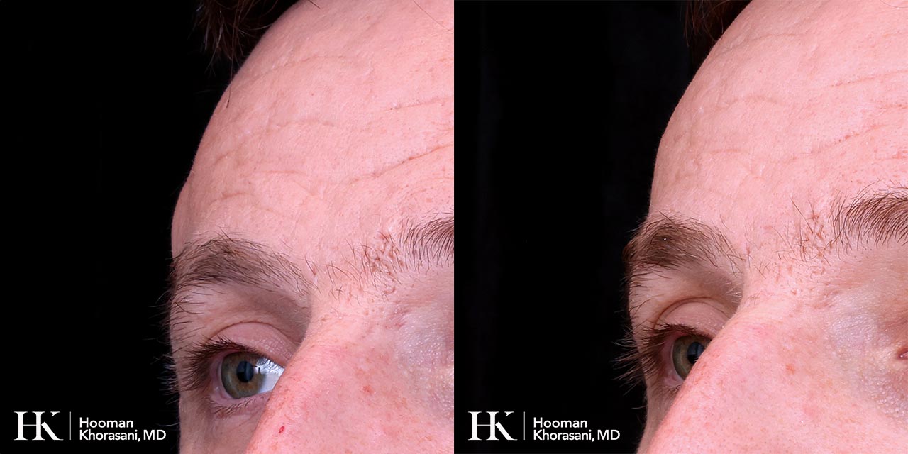 Cyst & Lipoma Removal Dr. Hooman Khorasani