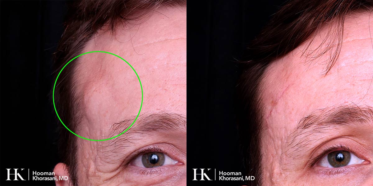 Cyst & Lipoma Removal Dr. Hooman Khorasani