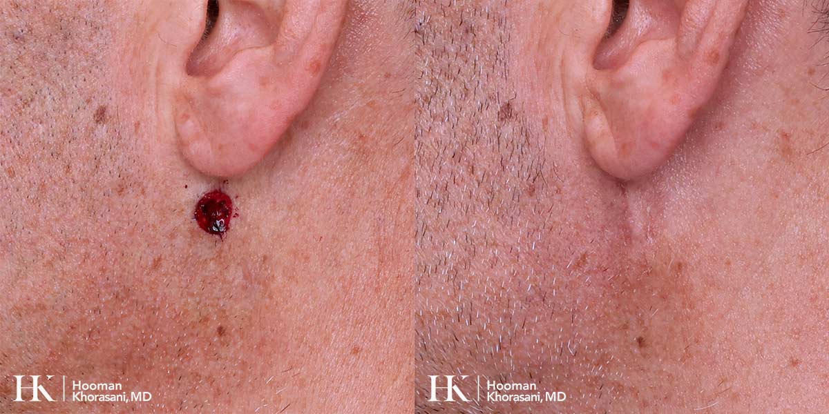 Mohs Micrographic Surgery & Reconstruction of the Cheek by Dr. Hooman Khorasani