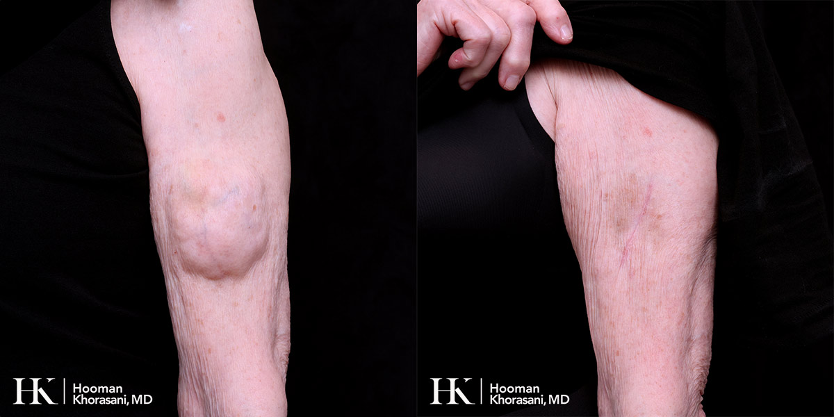 Lipoma Removal Dr. Hooman Khorasani