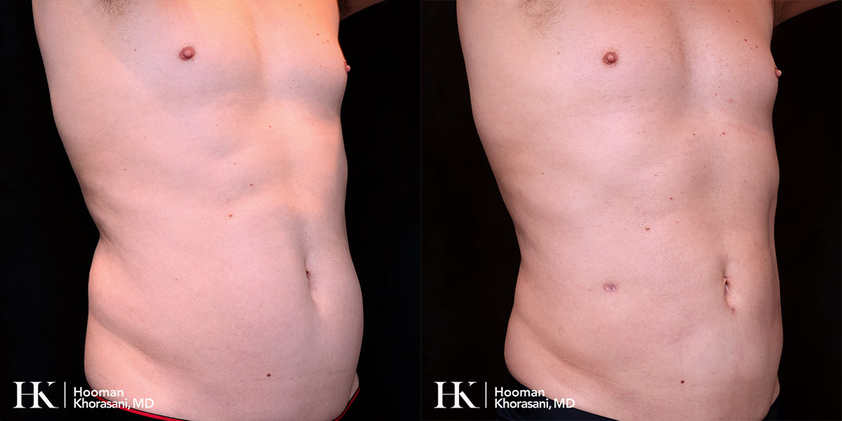 Liposuction of the body and Skin tightening by Dr. Hooman Khorasani