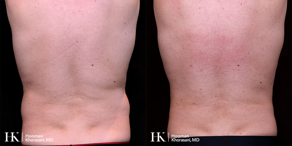 Liposuction of the body and Skin tightening by Dr. Hooman Khorasani