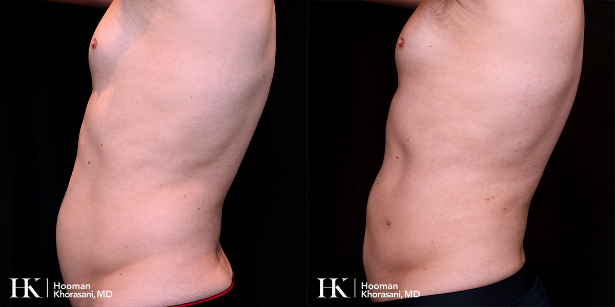 Liposuction of the body and Skin tightening by Dr. Hooman Khorasani