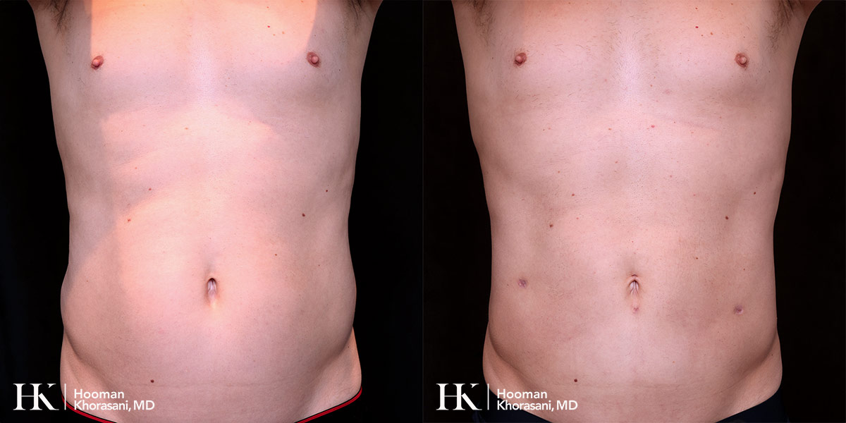 Liposuction of the body and Skin tightening by Dr. Hooman Khorasani