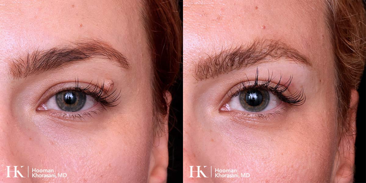 Cosmetic Mole Removal on Eyelid by Excision by Dr. Hooman Khorasani