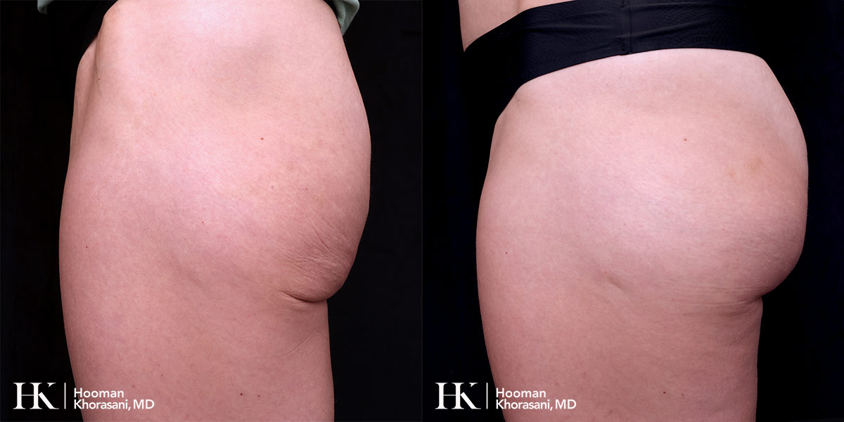 Buttocks Enhancement using Sculpra & Radiesse by Dr. Hooman Khorasani