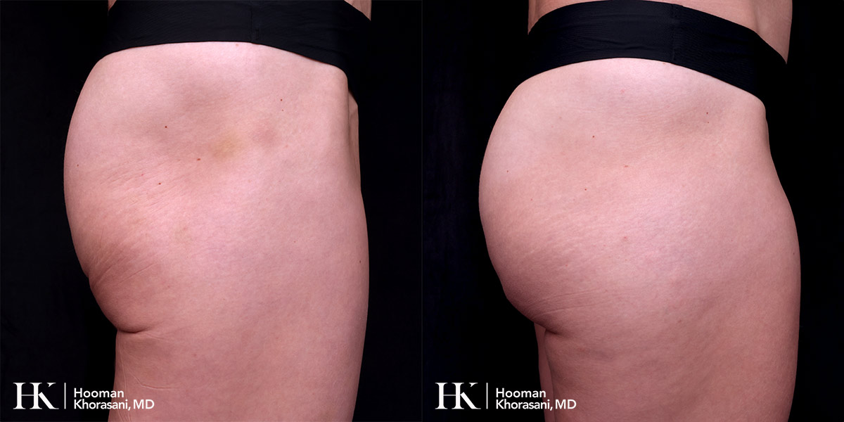 Buttocks Enhancement using Sculpra & Radiesse by Dr. Hooman Khorasani